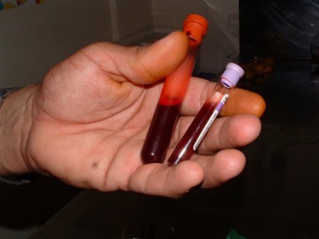 Зачем делать анализ крови при лейкозе?