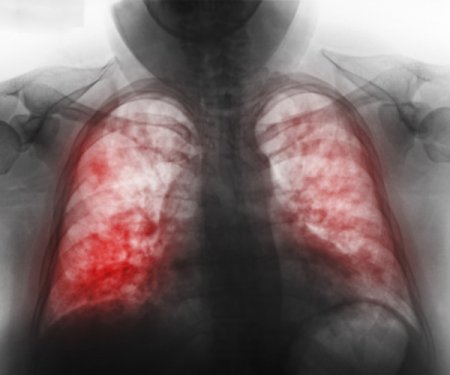 Что такое пневмония двухсторонняя и как её лечить?
